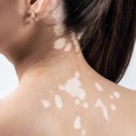 Vitiligo: Opțiuni de tratament la Microclinica Aviației Eridan